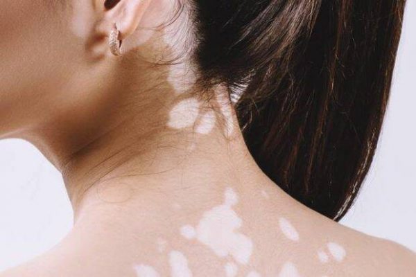 How to Cure Vitiligo Naturally ? - jyovis