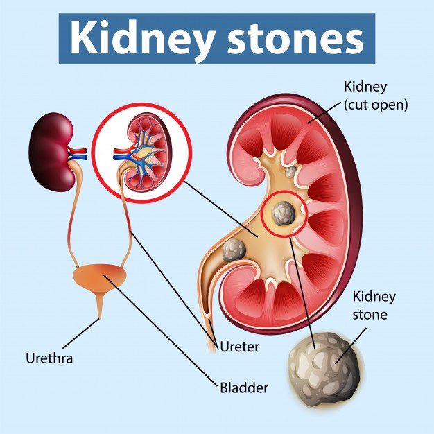 How to Get Rid of Kidney Stones Naturally? jyovis